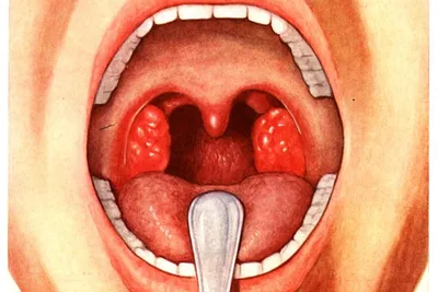 Ангина у ребенка: вирусная, грибковая, фолликулярная, катаральная симптомы  и лечение