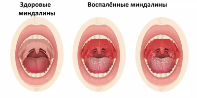 Сыпь На Корне Языка Прыщи Ближе к Горлу ЛюмиДент