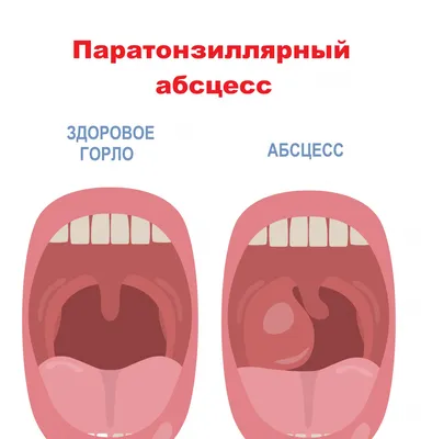 При ковид красное горло?(фото) - Советчица