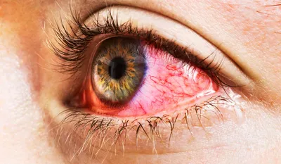 Как снять покраснение глаз 10 разными способами | Глаза, Красные глаза,  Разное