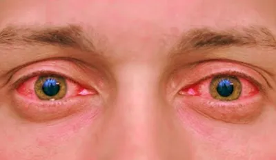 Почему глаза красные? - Полезная информация от клиники «КИТ»