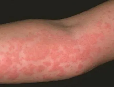 Красные пятна на теле | причины появления пятен на коже, лечение,  диагностика и профилактика