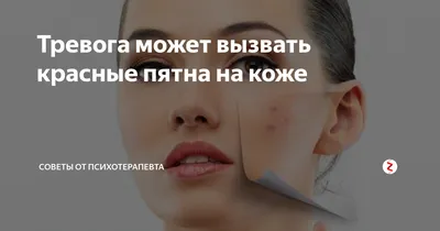 Дерматотропные средства МосФарма Суспензия "Циндол" - «Убрал 90% красных  пятен. Быстро!» | отзывы