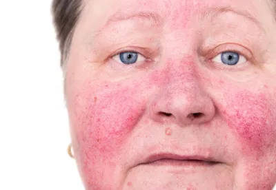 Что такое купероз кожи лица? Удаление сосудистой сеточки на лице лазером |  клиника Лазерсвiт
