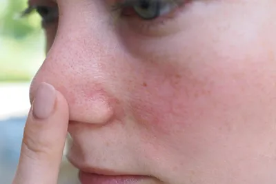Как вылечить купероз и розацеа на лице навсегда: 4 реальные истории |  Beauty Insider
