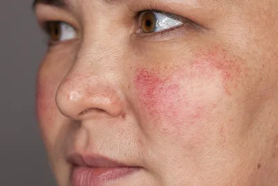 Удаление купероза (сосудистых звездочек) на лице, цена процедуры в клинике  «НаталиМед» в Москве в Строгино