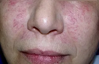 Купероз на лице: лечение