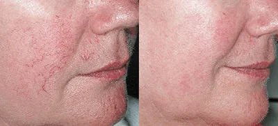 Купероз на лице — лечение купероза | Медицинский центр Эра