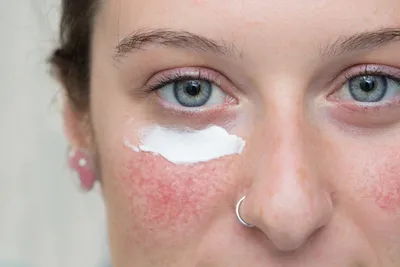 Купероз на лице: причины, симптомы, как избавиться. Hyalual - препараты для  коррекции купероза