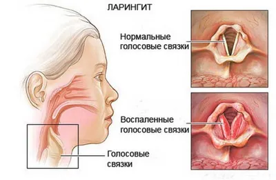 Ларингит: симптомы, лечение, острый, хронический, фото