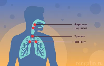 Фарингит, ларингит, трахеит, бронхит — как отличить болезни, вызывающие  кашель, друг от друга и чем их лечить