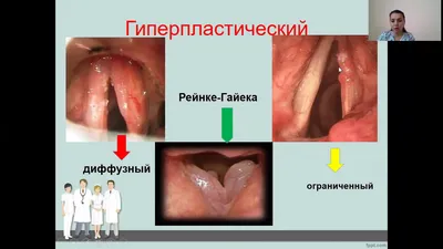 Ларингит у детей: лечение, симптомы с температурой и без, причины и  диагностика