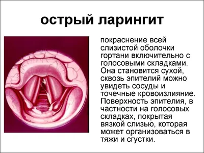 Лечение и профилактика ларингита у детей: что делать при ларингите