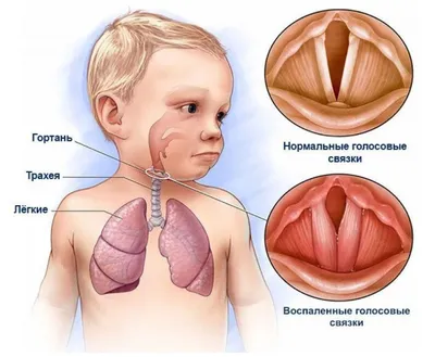 Ларингит у детей: причины, симптомы и методы лечения – Цитовир-3 для детей