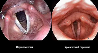 Ларингит: признаки, симптомы, лечение - МедКом