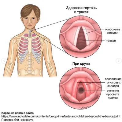 Лечение хронического ларингита у взрослых