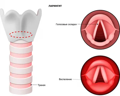 Ларингит (острый и хронический): причины возникновения, виды заболевания,  симптомы, способы лечения и профилактики | Формула здоровья | Дзен
