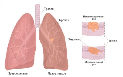 Операции при раке легких