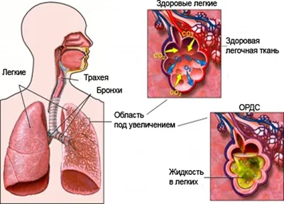 легкие человека окрашены в синий и оранжевый цвета, реальная картина  бронхита, бронхит, болезнь фон картинки и Фото для бесплатной загрузки