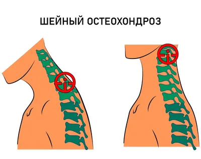 3 БЕЗОПАСНЫХ УПРАЖНЕНИЯ ПРИ ШЕЙНОМ ОСТЕОХОНДРОЗЕ ОТ ИНСТРУКТОРА ЦЕНТРА  ДОКТОРА БУБНОВСКОГО - YouTube