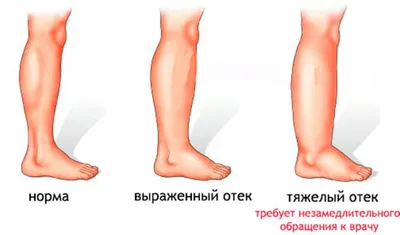 Лимфостаз — симптомы, причины и методы лечения болезни