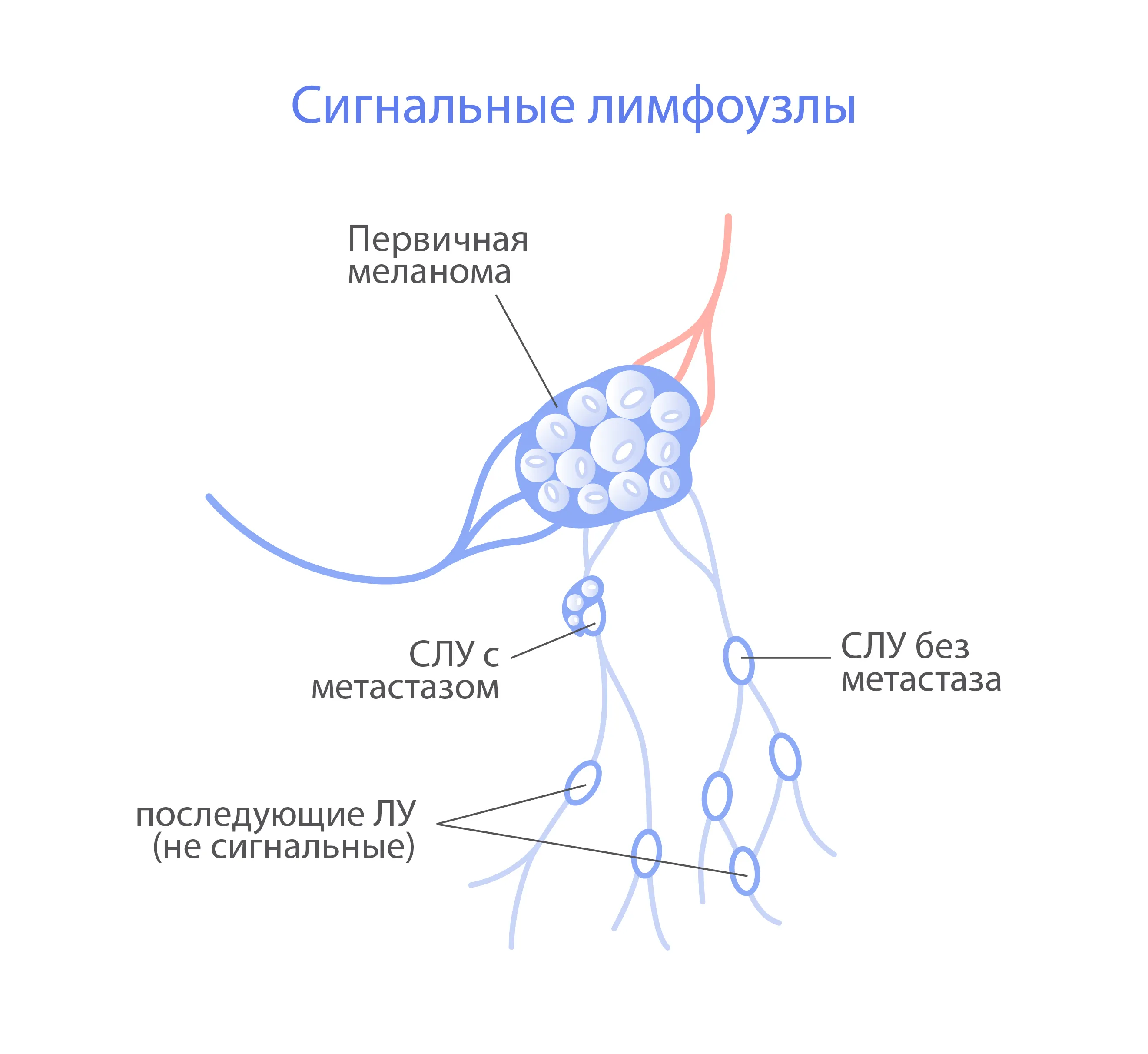 Сторожевой узел при раке молочной железы