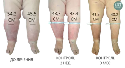 Лечение лимфедемы | подробно про метод Лимфатек