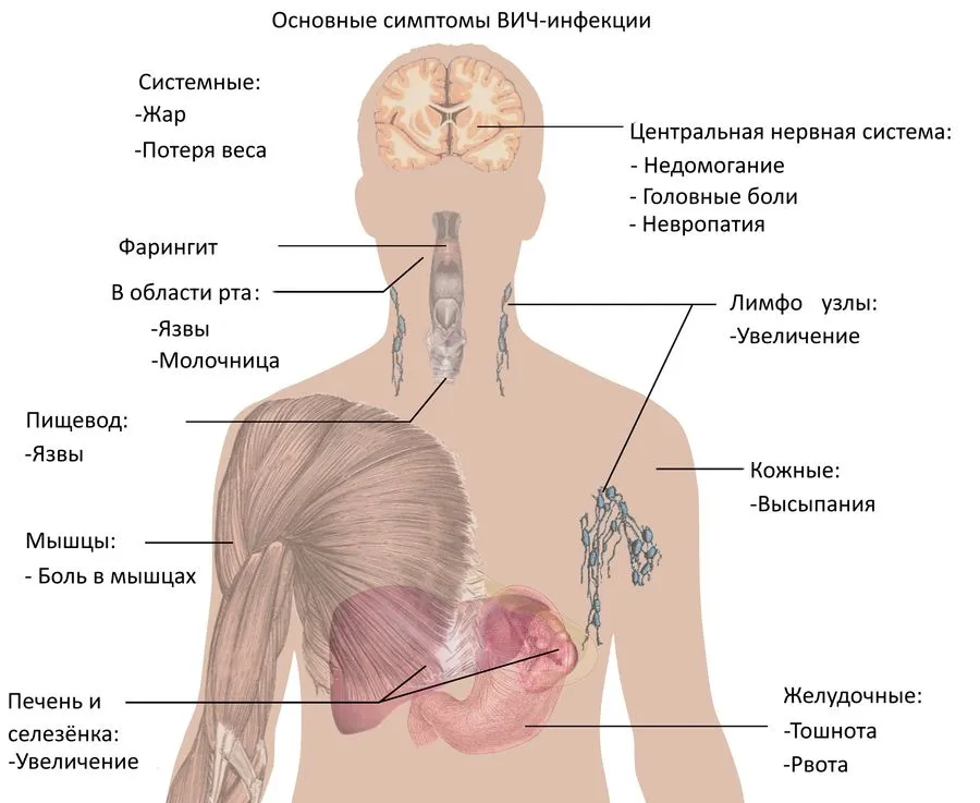 Вич инфекция лимфоузлы