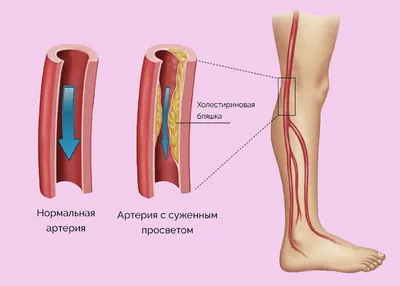 Лимфатический Отек Конечностей (Лимфедема). Причины Лечение