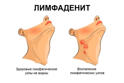 Атеросклероз нижних конечностей - симптомы и лечение в СПб | Клиника  МедПросвет