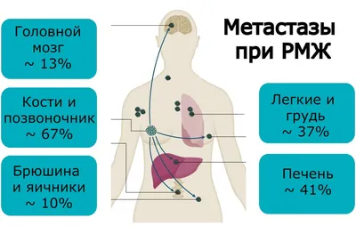 Метастазы при раке молочной железы - методики лечения 2023