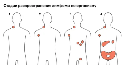 Рак полового члена: симптомы, признаки, диагностика, лечение