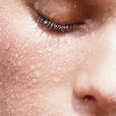 Как сократить жировики на лице: эффективные методы для безупречной кожи |  Красота в Гармонии с Здоровьем: Твой Гид к Идеальному Образу в Одном месте  | Дзен
