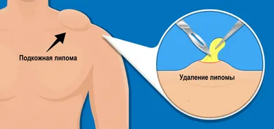 Удаление жировиков (липом) в клинике инновационных медицинских технологий  «Градиент» в Москве