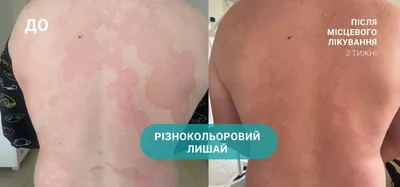 Опоясывающий лишай (опоясывающий герпес, herpes zoster): симптомы и  профилактика