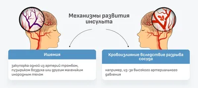 Реабилитация после инсульта в Набережных Челнах