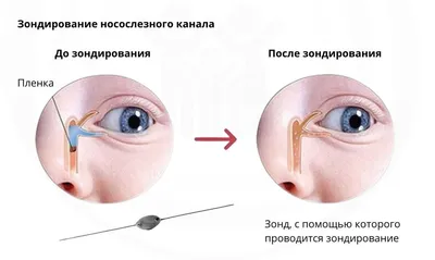 Зондирование носослезного канала при дакриоцистите или закупорке  носослезного канала - «Мамочки, а также те, кто только планирует  беременность, ВЫ ОБЯЗАНЫ ПРОЧЕСТЬ ЭТОТ ОТЗЫВ, ЧТО БЫ ЗНАТЬ, КАК СОХРАНИТЬ  ЗДОРОВЬЕ СВОЕМУ РЕБЕНКУ, на