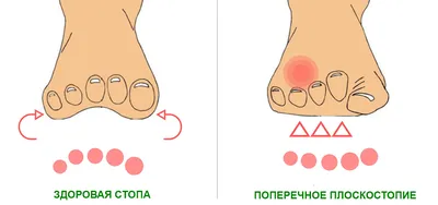 Как убрать ПЛОСКОСТОПИЕ раз и навсегда? Профессиональный массаж стоп от  плоскостопия - YouTube