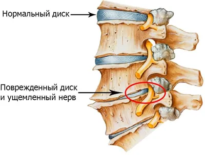 Все о массаже при остеохондрозе - техники для спины и шеи