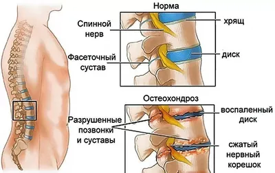 Остеохондроз: методы лечения, упражнения и ЛФК | Здоровье