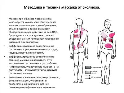 МЕТОДИКА МАССАЖА ПРИ ПРАВОСТОРОННЕМ ГРУДНОМ И ЛЕВОСТОРОННЕМ ПОЯСНИЧНОМ  СКОЛИОЗЕ, ЧАСТЬ I. | ВКонтакте