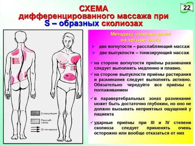 Массаж при сколиозе позвоночника 1,2 степени: как правильно делать