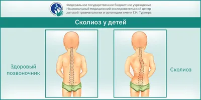 Сколиоз позвоночника: какой врач лечит у взрослых и детей?