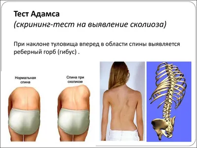 Массаж при сколиозе - Медцентр неврологии и остеопатии "на Школьном 5"