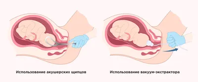 Разрывы во время родов: описание основных причин и мер профилактики