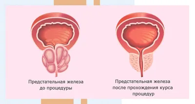 Массаж простаты