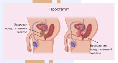 Лечение аденомы предстательной железы | Блог клиники "БИНА"