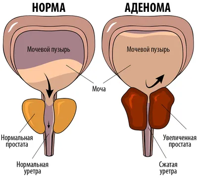 Признаки аденомы простаты у мужчин – симптомы и описание