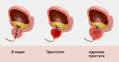 Прямой и непрямой самомассаж простаты