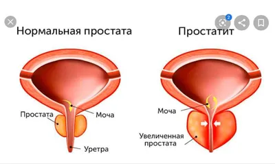 Массаж простаты ... — Ак Жайык